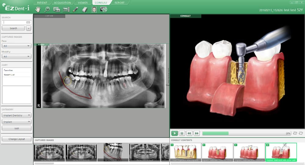 Zubní software - EzDent-i Implant - 1