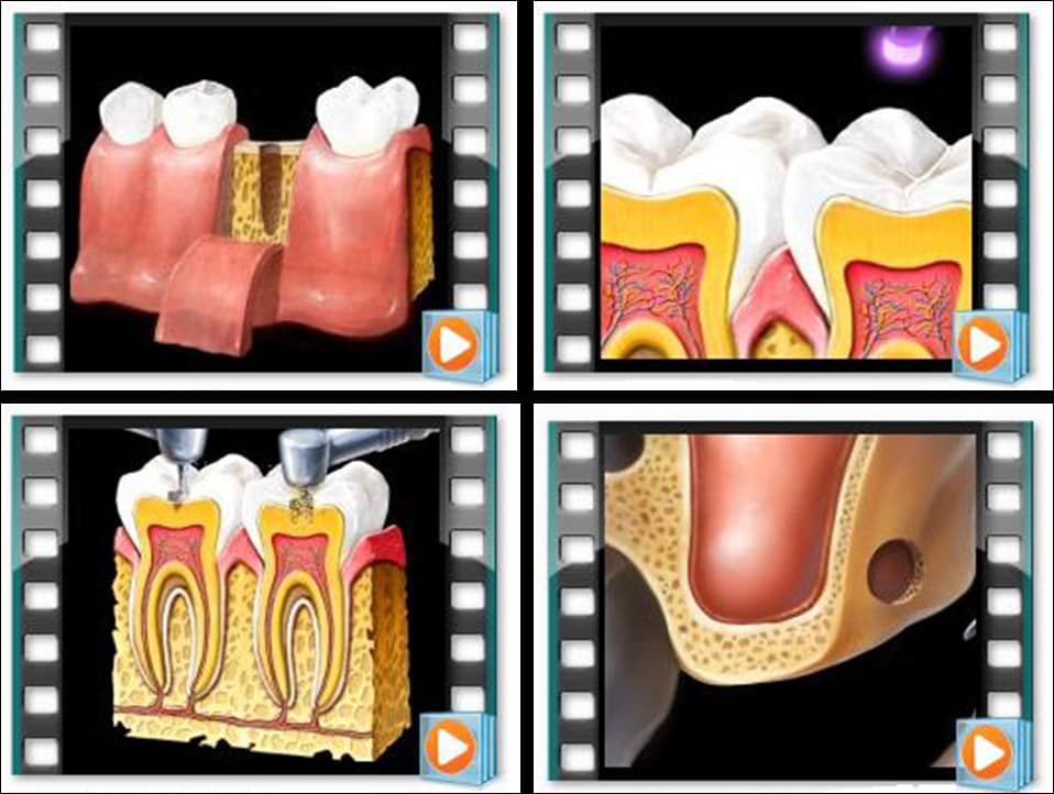 Zubní software - EzDent-i Implant - 2